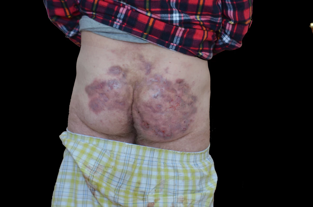 Gluteální postižení hidradenitis suppurativa