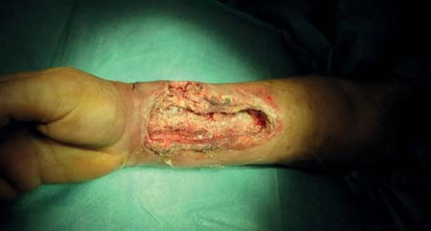 Perioperační nález
Fig. 2: Perioperative finding