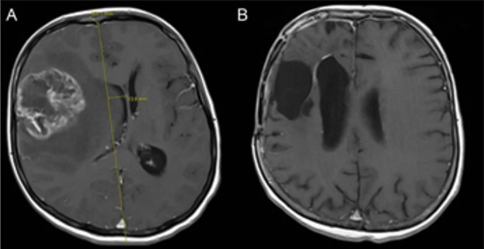 MR 6 let žijící pacientky s glioblastomem, operované v 52 letech (2 operace, ra diochemoterapie, boost gama nožem). (A) Předoperační MR zobrazuje významný stře dočárový přetlak. (B) MR po 6 letech bez recidivy (druhá operace provedena interhemis fericky kvůli atrofi i kůže v původním přístupu pro recidivu frontálně periventrikulárně). Fig. 4. MRI of a female patient with glioblastoma with 6-year overall survival, operated  on at 52 years of age (2 surgeries, radiochemotherapy, gamma knife boost). (A) Preope rative MRI shows a signifi cant midline shift. (B) MRI after 6 years without recurrence (the  second surgery for frontal periventricular recurrence was approached interhemispheri cally due to skin atrophy in the original craniotomy site).