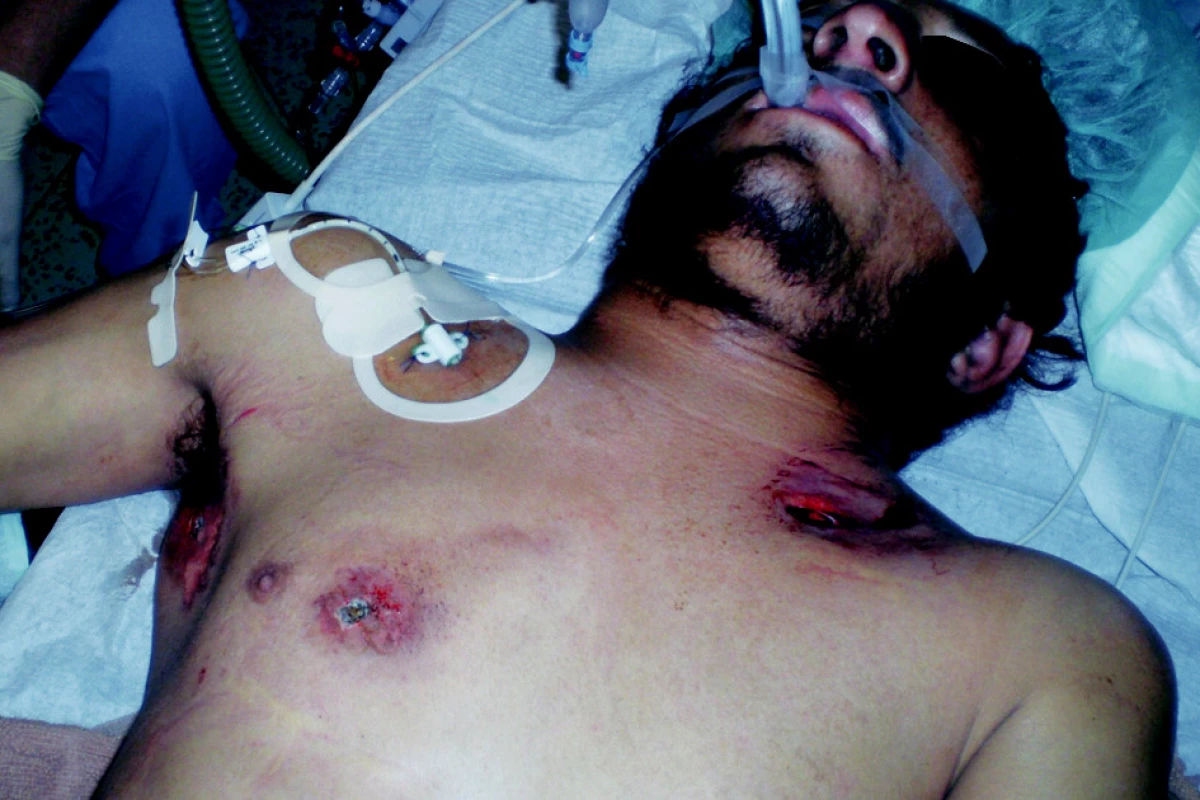 Vstřel a výstřel na přední stěně hrudníku a vstřel v pravé axile
Fig. 2. Gunshots of the anterior chest wall and in the right axilla