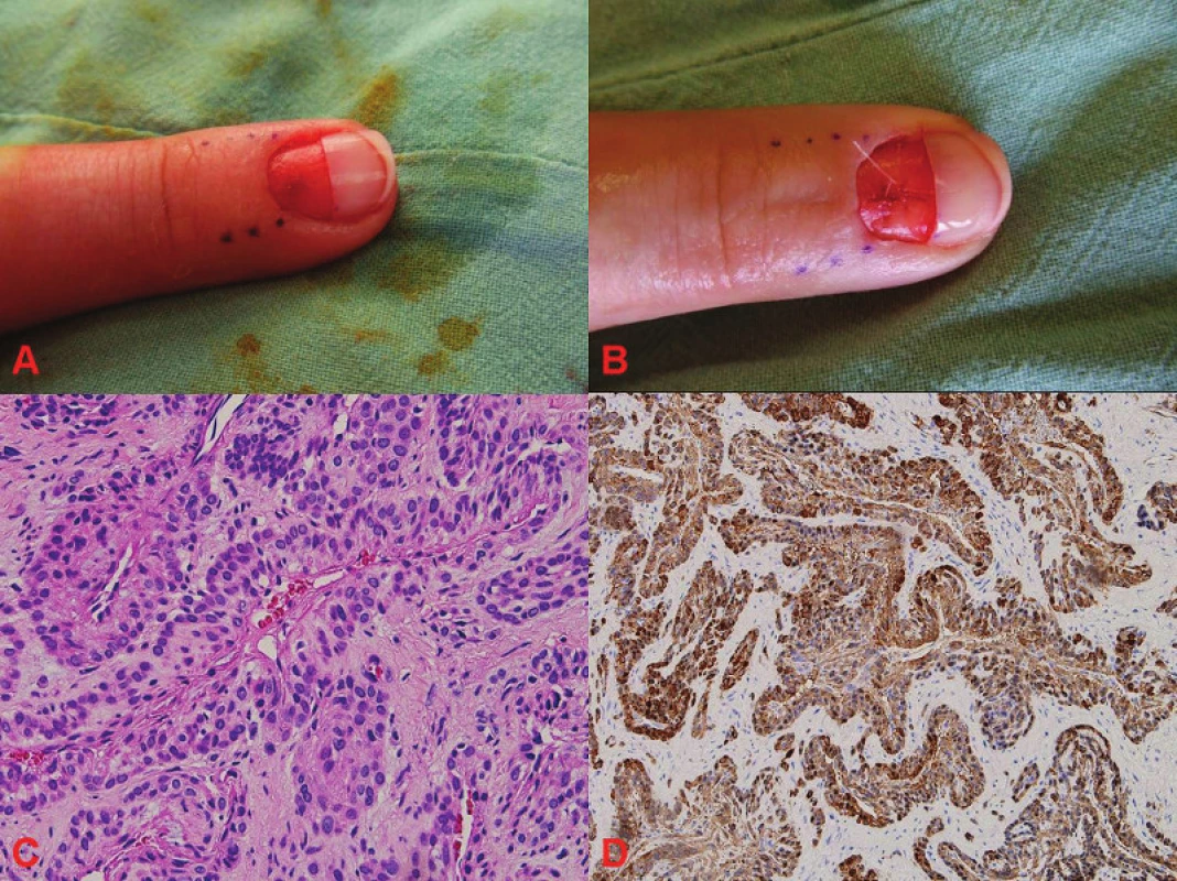 Glomus tumor
A: pacientka po proximální, příčné ablaci nehtové ploténky s obnažením subunguálního prostoru s glomus tumorem nehtového lůžka 
B: stav po excizi glomus tumoru
C: histologický obraz glomus tumoru, barvení hematoxylin- eozin (HE)
D: histologický obraz glomus tumoru, histochemické vyšetření, barvení α-SMA