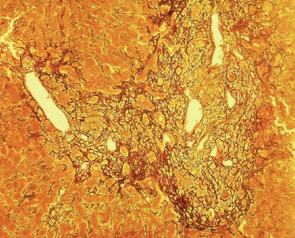 Fibrotizace a rozšíření portálních polí (barvení retikulin)