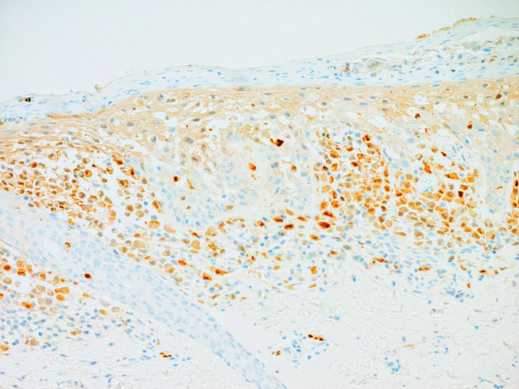 Pozitivní imunohistochemický průkaz S100 povrchového antigenu v nádorových buňkách, 200x zvětšeno.
Fig. 7. Positive imunohistochemical demonstration of S100 surface antigen in tumorous cells, 200x enlargement.