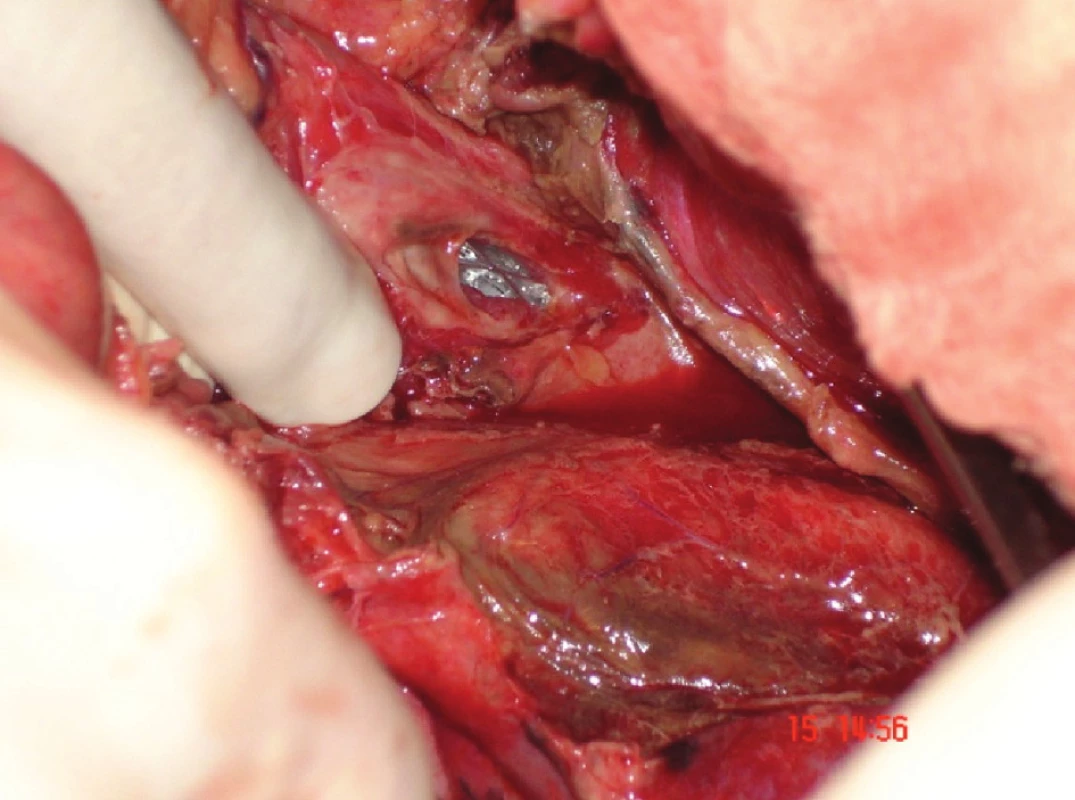 Peroperačně zavedený stent (pacienta z Obr. 1) – následovala sutura jícnu posílená fundoplikací
Fig. 2: A stent applied surgically (patient in Fig. 1) – followed by oesophageal suture supported by fundoplication