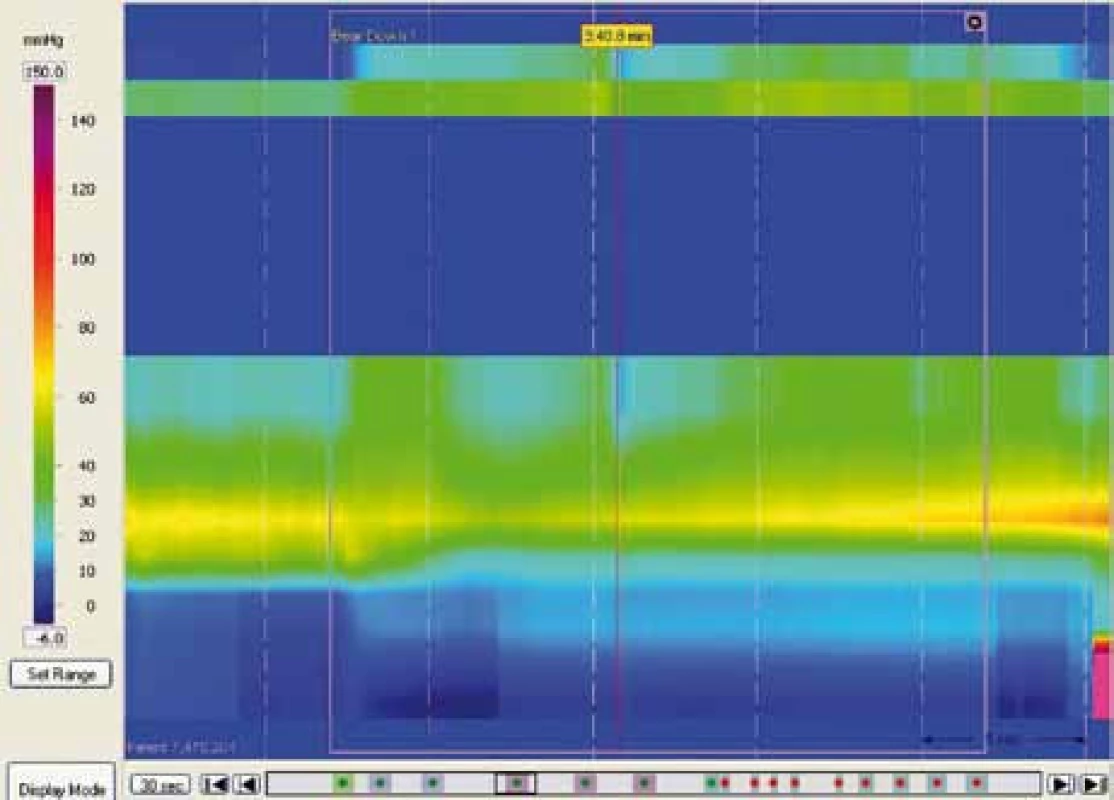Dysynergní defekace typu III – chybění nebo neadekvátní relaxace análního svěrače při simulované defekaci.
Fig. 13. Dyssynergic defecation type III – absent or inadequate anal sphincer relaxation in simulated defecation.