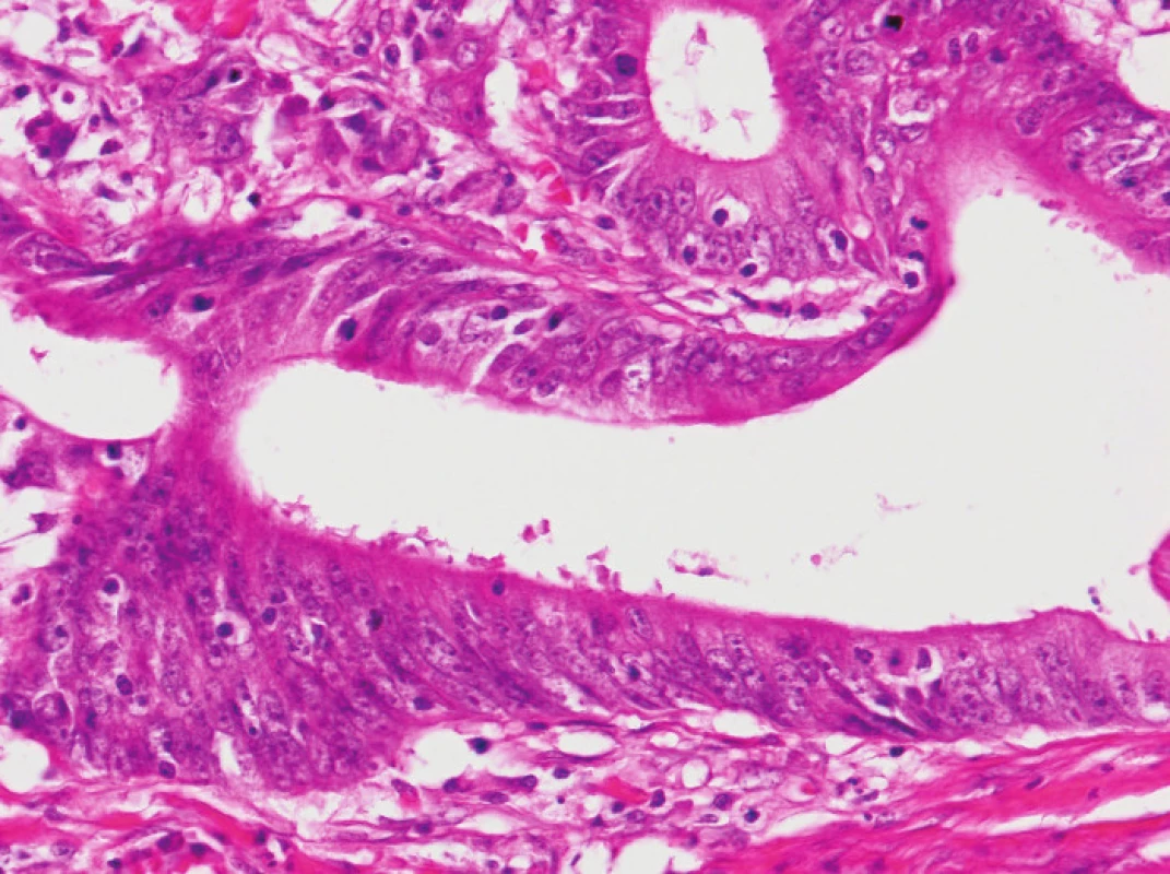Tumor-infiltrující lymfocyty ve větším detailu (HE, původní objektiv 20x).