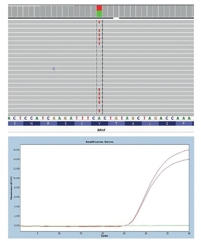 Detekce bodové mutace BRAF V600E
Na obrázku nahoře detekce pomocí masivně paralelního sekvenování a její vizualizace pomocí programu Integrative Genomic
Viewer (záměna nukleotidu A za T způsobující záměnu aminokyseliny valin za glutamát. Na obrázku dole detekce
pomocí alelicky specifického Real-Time PCR (červeně pacient s mutací BRAF V600E, zeleně negativní kontrola).<br>
Fig. 1: BRAF V600E point mutation detection
In the picture above, detection by massively parallel sequencing and its visualization using the Integrative Genomic Viewer
program (replacement of nucleotide A to T causing the amino acid substitution of valine for glutamate. control). In the figure
below, detection by allele-specific Real-Time PCR (red patient with BRAF V600E mutation, green negative control).