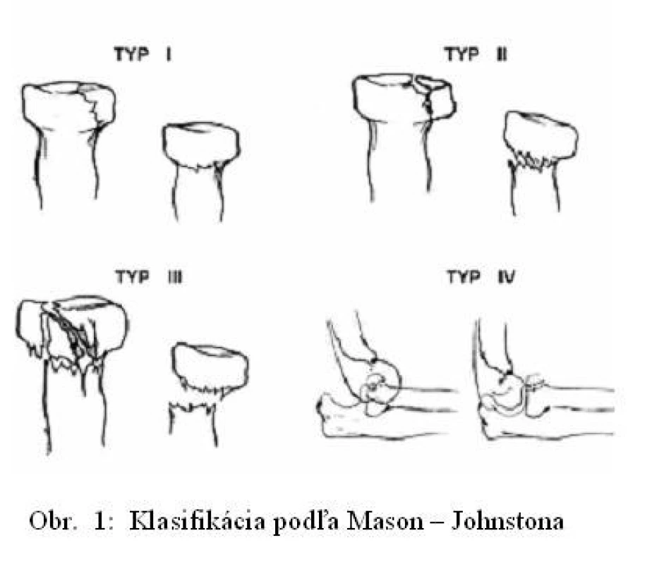 Klasifikácia podľa Mason–Johnstona