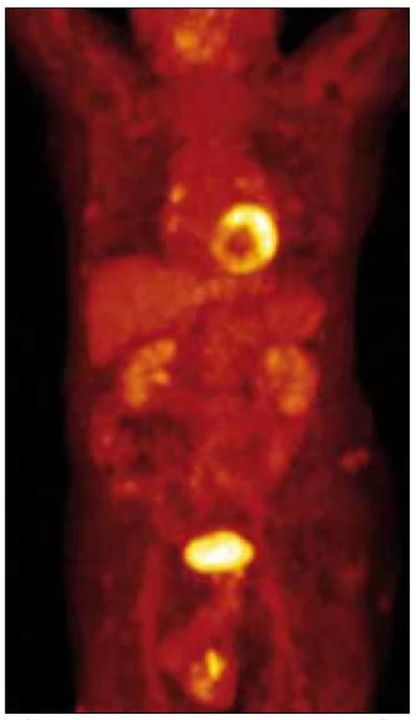 PET CT trupu, není patologická aktivita.