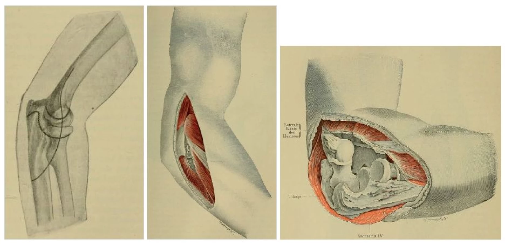 Originální Kocherův přístup z roku 1907: a – kožní řez ve tvaru „J“; b – preparace v intervalu mezi m. extensor carpi ulnaris a m. anconeus; c – uvolnění všech struktur upínajících se na laterání epikondyl humeru a široké rozevření kloubu.
Fig. 1: Original Kocher approach of 1907: a – J-shaped skin incision; b – dissection in the interval between the extensor carpi ulnaris and the anconeus; c – release of all structures attached to the lateral epicondyle of the humerus and opening the joint wide.