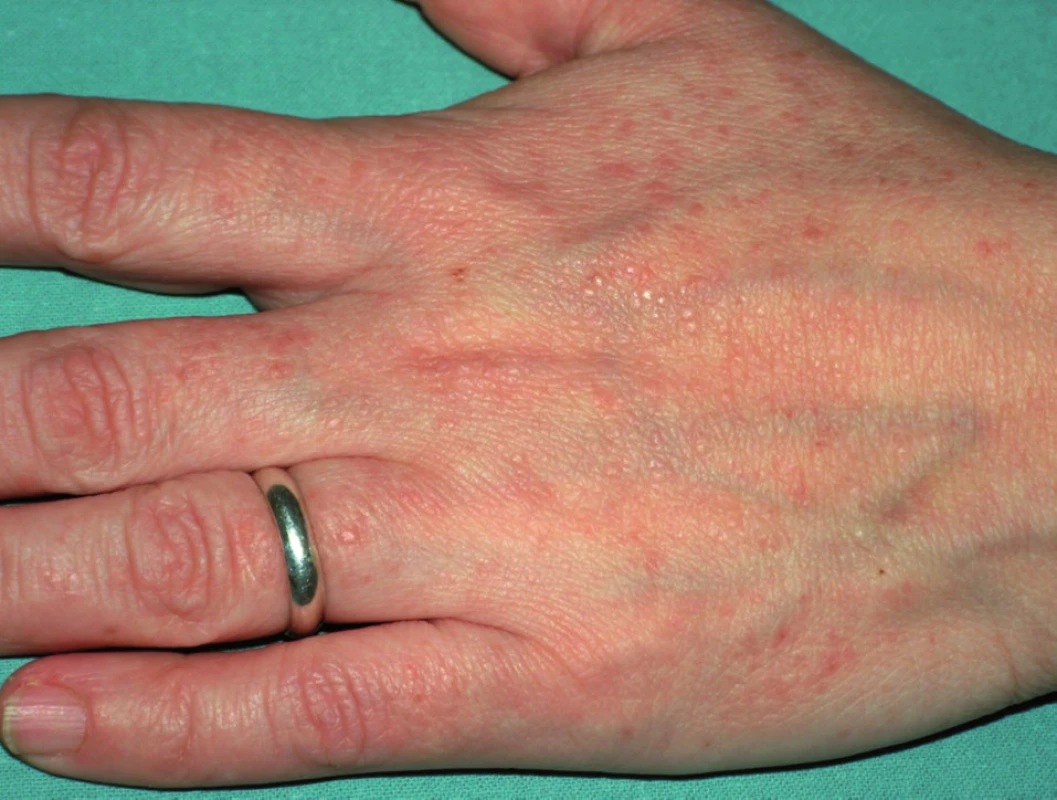 Morbus Darier – acrokeratosis verruciformis: ploché světle červenohnědé papuly připomínající ploché bradavice.