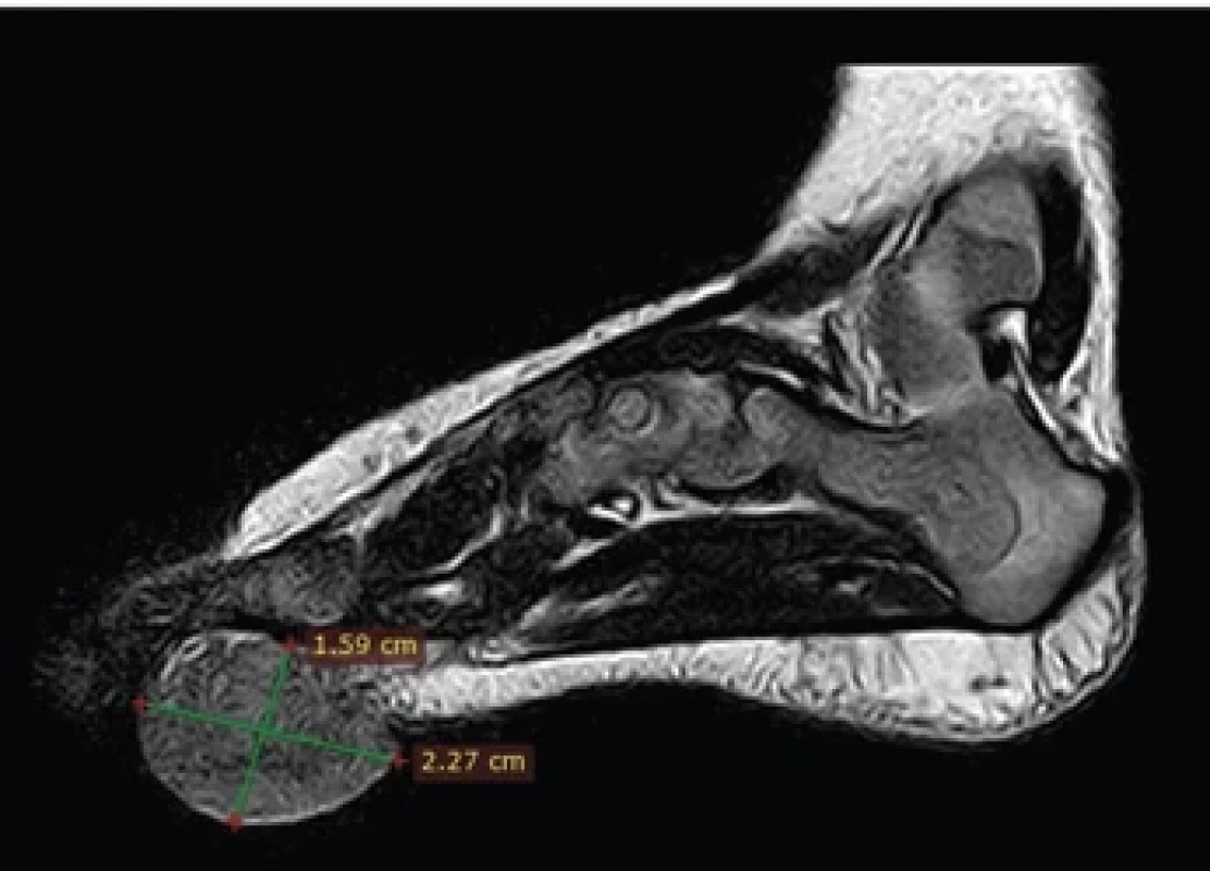 T2 sagittal view, uniform hypointense subcutaneous soft tissue mass seen in the relatively hyperintense plantar forefoot measuring 2.27 × 1.59 cm.