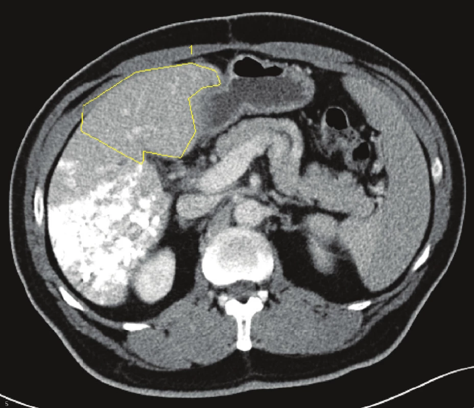 Embolizace pravé větve portální žíly u metastáz kolorektálního karcinomu do jater s volumometrií levého laloku
