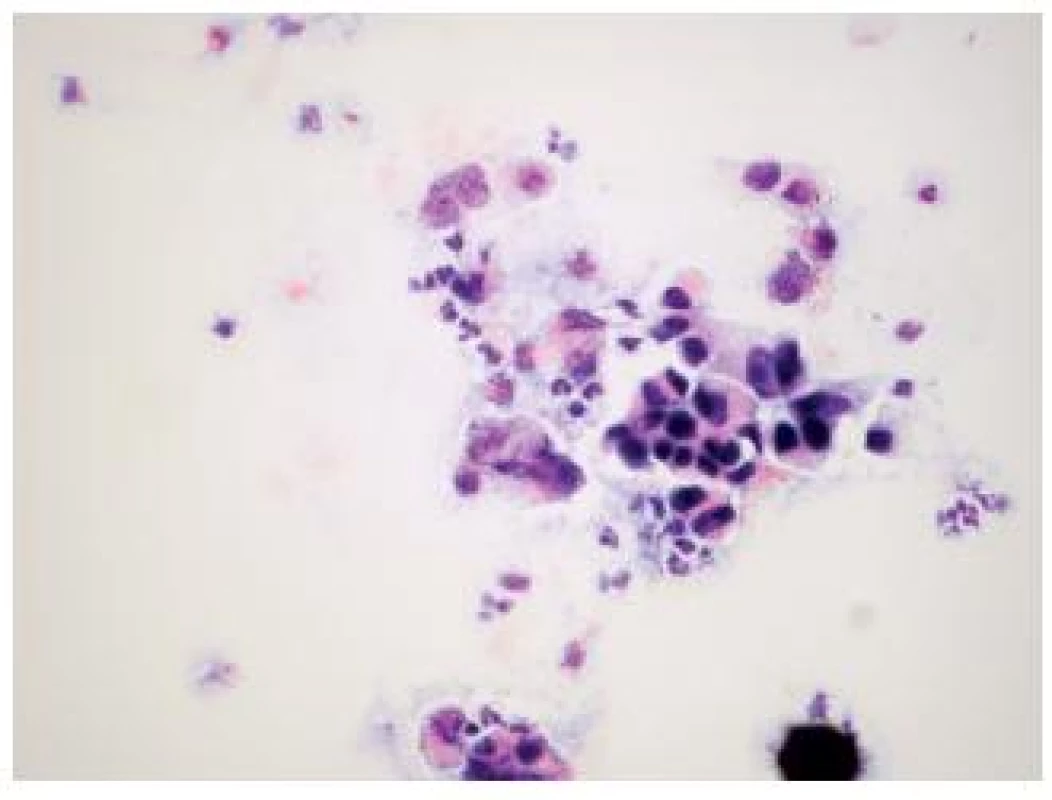 Low grade papilárny uroteliálny karcinóm u 66 ročného pacienta s mikrohematúriou, pozitívnym cystoskopickým nálezom a biopticky na inom pracovisku potvrdeným papilárnym uroteliálnym karcinómom WHO grade 2. (Cytospinový preparát, farbenie PAP, zväčšenie 400x.)