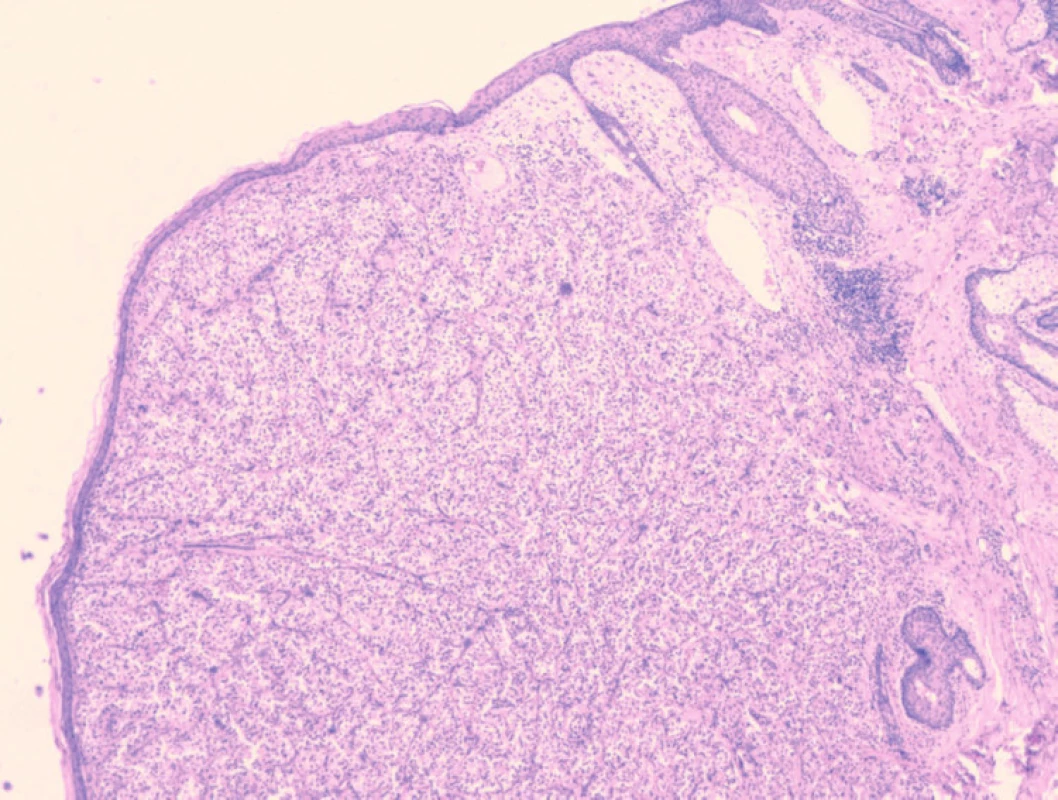 Histologický obraz kožnej metastázy – celkový pohľad (hematoxylín-eozín, 40x).