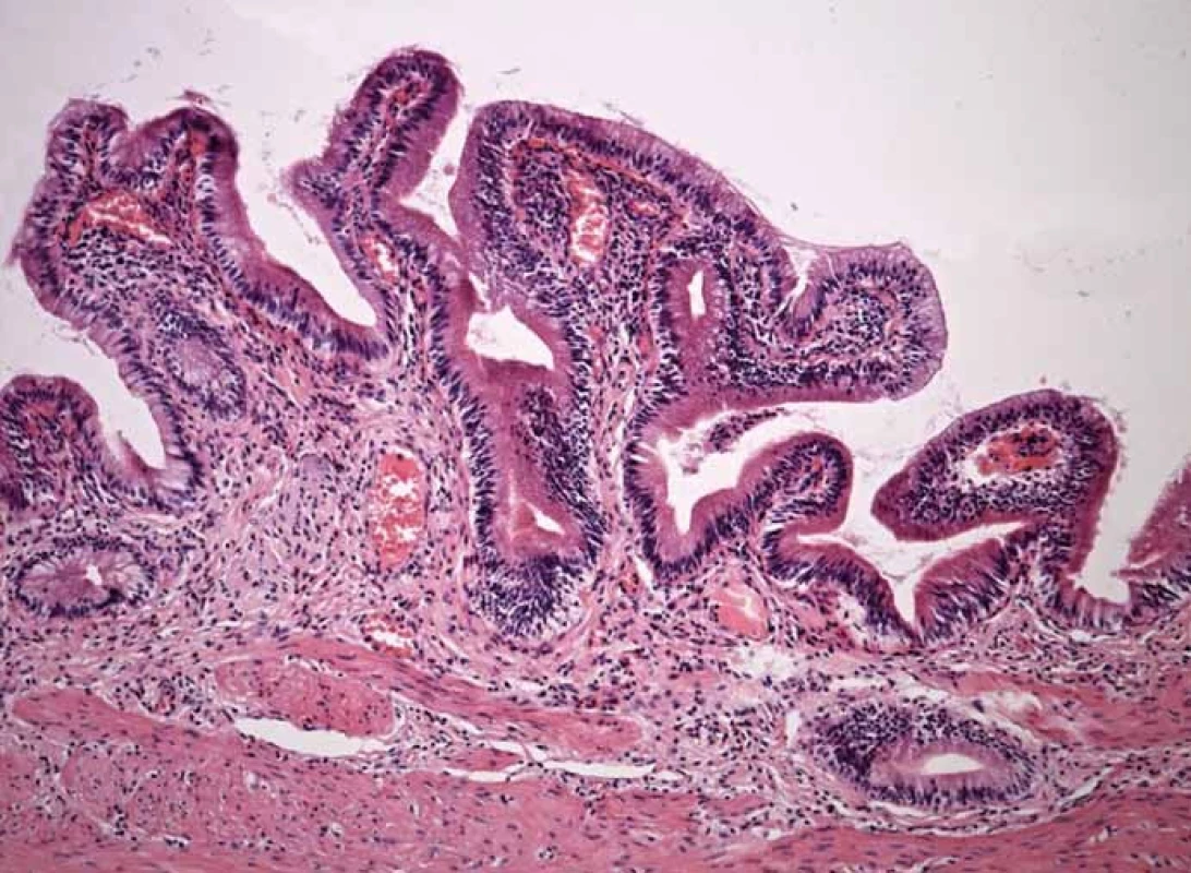 Histologický obrázek – lehce ztluštělá stěna žlučníku s chronickou zánětlivou infiltrací stěny.
Fig. 1. Histological image – slightly thickened gallbladder wall with chronic inflammatory infiltration.