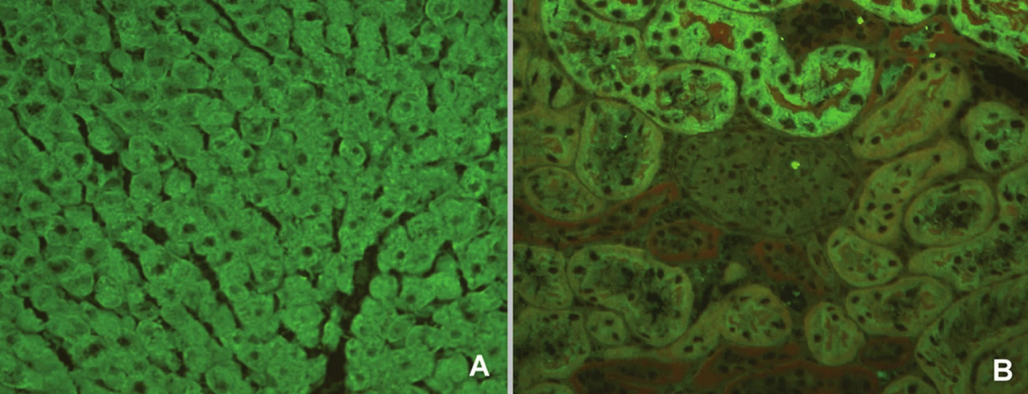 Imunofluorescenční obraz protilátek proti mikrozomálnímantigenůmjater a ledvin 1 (substrát – krysí játra a ledvina, A – jaterní buňky, B – proximální tubuly).
Fig. 5. Immunofluorescent image of anti-liver kidney microsome antibodies 1 (substrate – rat liver and kidney, A – liver cells, B – proximal tubules).