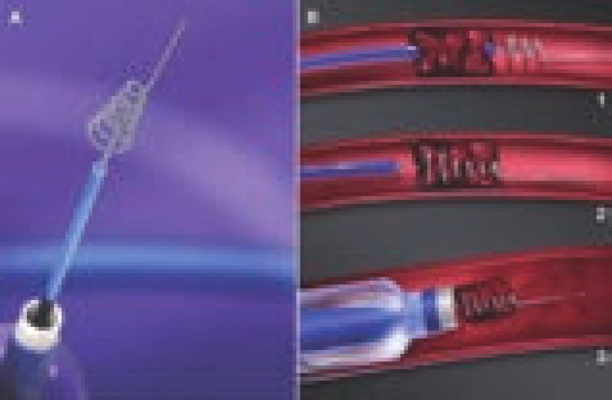 Schematické znázornění extrakce trombu pomocí Merci katetru.