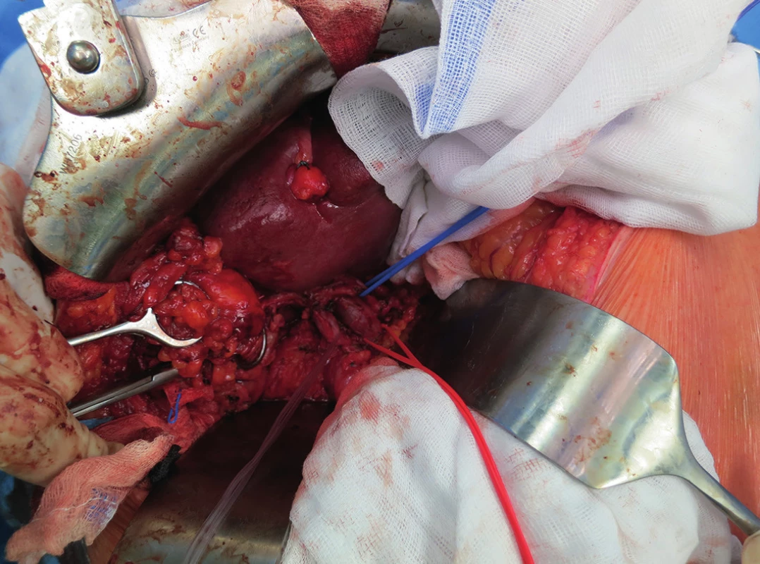 Zánětlivě změněný žlučník a provedená lymfadenektomie hepatoduodenálního ligamenta
Fig. 2: Gall bladder changed by inflammation and performed lymfadenectomy of hepatoduodenal ligament