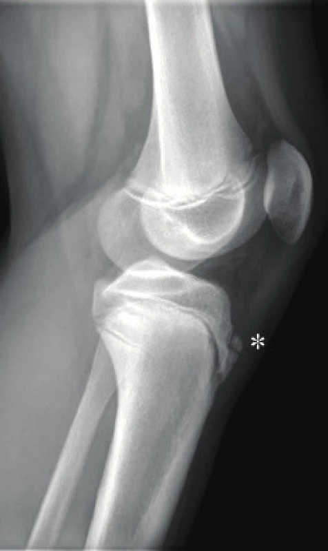 RTG obraz onemocnění Morbus Osgood-Schlatter (bočná projekce) – značka určuje fragmentaci tuberositas tibiae.
Fig. 6. X-ray of Osgood-Schlatter dissease (lateral view) – fragmentation of tibial tuberosity marked.