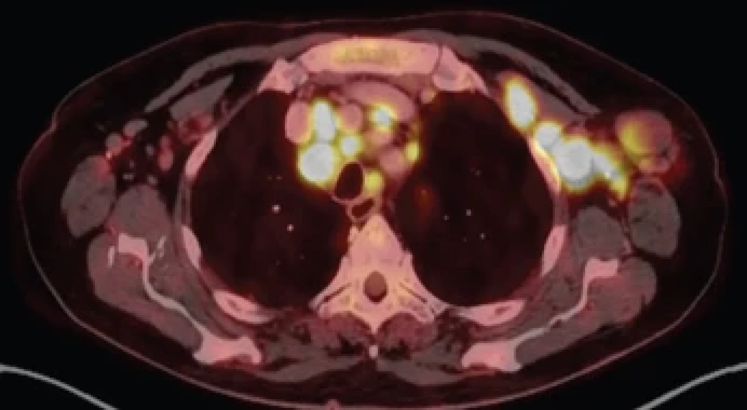 PET/CT. Zvýšená akumulace 18F-FDG ve vícečetných zvětšených LU nad i pod bránicí, v mnohočetných ložiscích obou plic i na pleuře, ojediněle v ložisku na peritoneu. Splenomegalie.