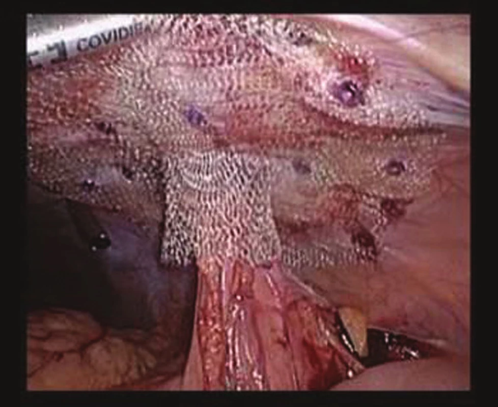 Síťka implantovaná při primární operaci
Fig. 1: Primary implanted mesh