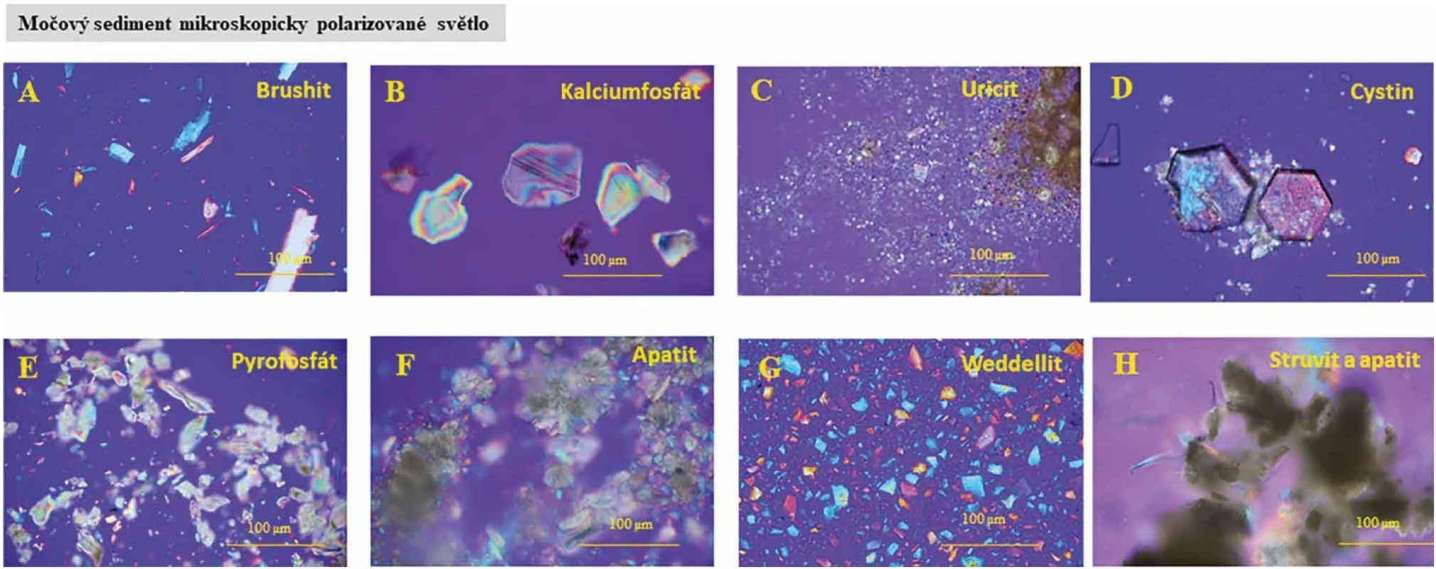 Mikroskopická analýza močového sedimentu v polarizovaném světle: A – brushit s typickým barevným přechodem (hydrogenfosforečnan vápenatý dihydrát); B– typické krystaly s optickými rozhraními kalciumfosfátu; C – drobné krystalky uricitu (kyselina močová); D – typické hexagonální krystaly se zřetelnými optickými efekty u cystinu; E – výrazné zastoupení solí nebo esterů kyseliny difosforečné tvořící pyrosfáty; F – přítomnost apatitu v jehlicovité formě (trihydrát fosforečnanu vápenatého); G – silné zastoupení přítomnosti oxalátu whewellitu (šťavelan vápenatý); H – opticky méně výrazná přítomnost tripelfosfátu struvit (heptahydrát fosforečnanu amono-hořečnatého) a apatitu. Vzorek moči je krátce centrifugován a následně 50 µl naneseno na podložní sklíčko a vysušeno na vzduchu. Vzorek je manuálně sledován v mikroskopu při zvětšení 120 a 240krát. Následně je snímán digitálním fotoaparátem a uložen do počítače k následnému vyhodnocení.