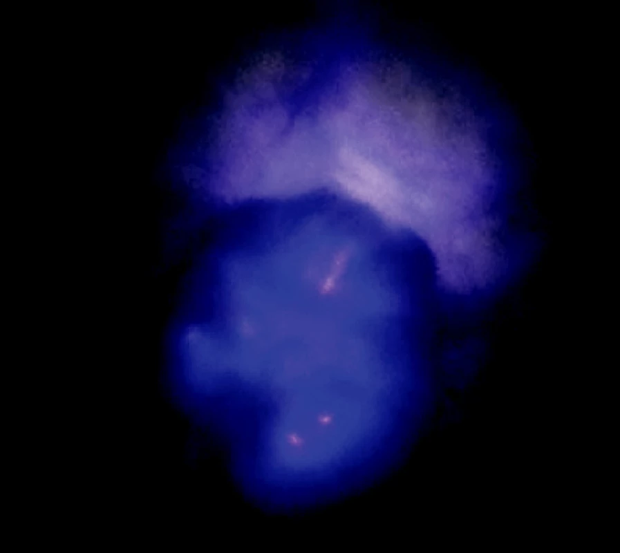 Ložisko adenokarcinómu v autofluorescenčnom obraze
Fig. 4. An autofluorescence view of the adenocarcinoma focus
