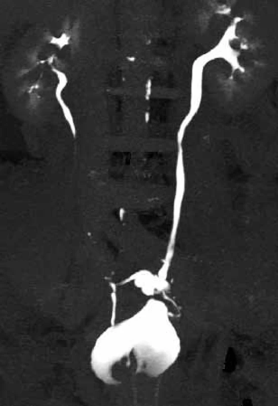 CT-IVU – únik kontrastní látky mimo lumen distálního levého ureteru, kontrastní látka se hromadí presakrálně
Fig. 5. CT-IVU – leakage of the contrast substance outside the lumen of the distal ureter on the left side, the contrast substance escapes in front of the sacrum