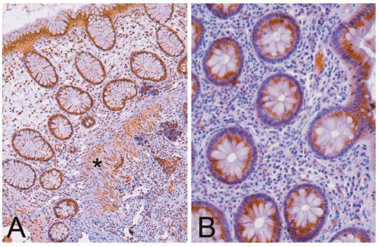Type-1 adiponectin receptor in the cytoplasm of colonocytes, lymphocytes and smooth muscle cells (*) of the colon. Immunoperoxidase method, counterstained slightly by hematoxylin, original magnification 200x (A) and 400x (B).