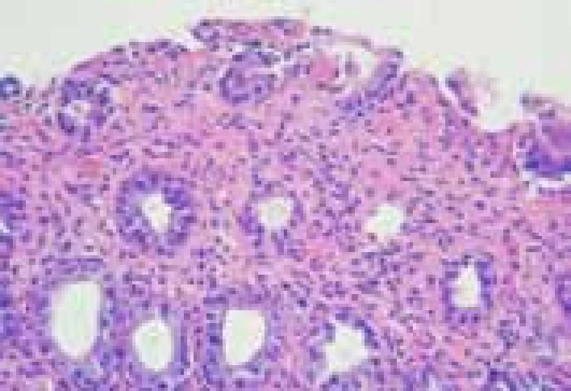 Histologický nález v rektosigmatu ve vzdálenosti 35 cm od análního okraje (z archivu prim. MUDr. I. Vítkové z Hlavova patologicko-anatomického ústavu v Praze).