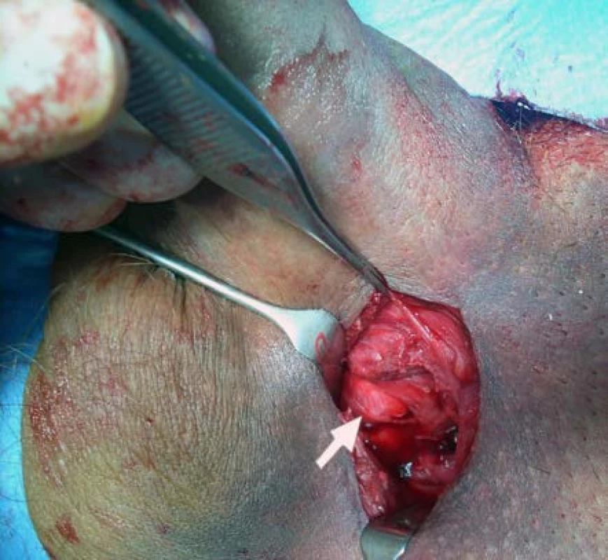 Peroperační nález ruptury tunica albuginea po evakuaci hematomu
Fig. 3. Intraoperative finding of rupture of the tunica albuginea following haematoma evacuation