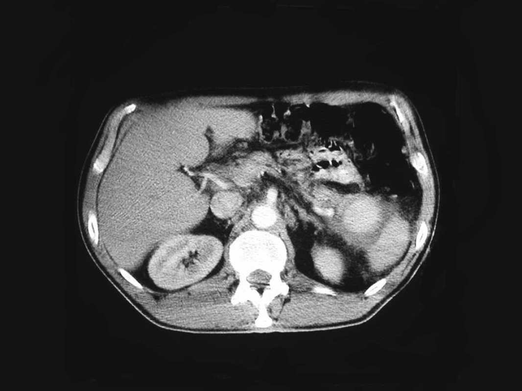 Kontrastní CT sken s průkazem promývaného pseudoaneuryzmatu po narušení slezinné tepny v prosinci 2004
Fig. 2. Contrast CT scan demonstrating a contrast-filled pseudoaneurysm resulting from the splenic artery invasion in December 2004