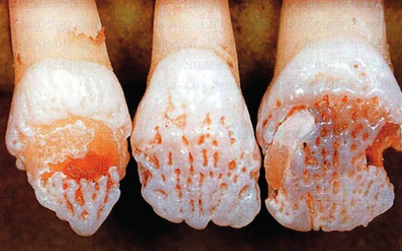 Hypomineralizace skloviny (amelogenesis imperfecta). (dle: Cawson RA, Odell EW, Porter S. Cawson´s Essentials of Oral Pathology and Oral Medicine. Churchill Livingstone, 2008. ISBN 0 443 071055).
Fig. 1. These teeth an affected female show the typical vertical ridged pattern of normal and abnormal enamel as a result of lyonisation.