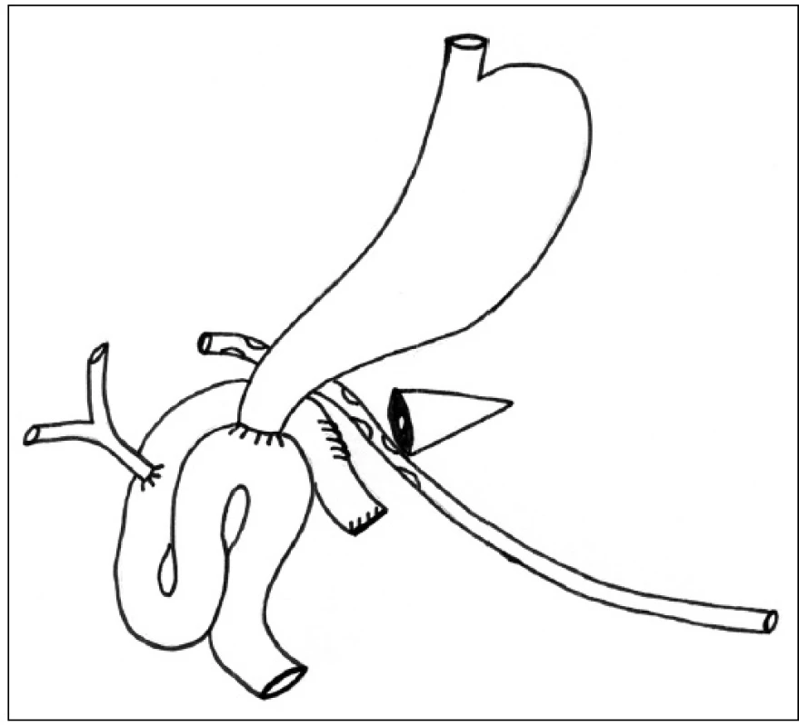 Ošetření pankreatické píštěle dekonexí PJA a retrogastrickou drenáží zbytku pankreatu
Fig. 2: Pancreatic fistula management with PJA disconnecting and retrogastric drainage of the pancreatic remnant