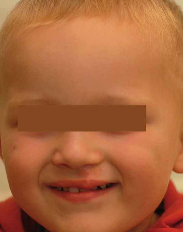 Pacient tři roky po operaci.
Fig. 2. Patient three years after the surgery.