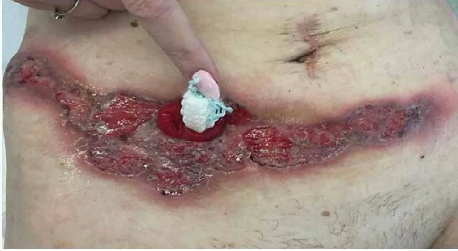 Peristomicky lokalizovaná PG v úvode hospitalizácie