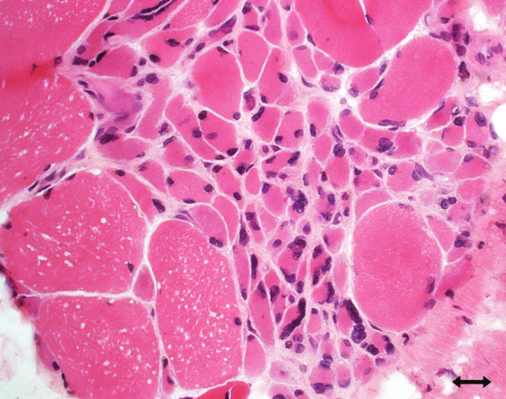 Atrofická, polygonální, částečně regenerující svalová vlákna ve skupinách svědčící pro denervaci (hematoxylin-eozin).