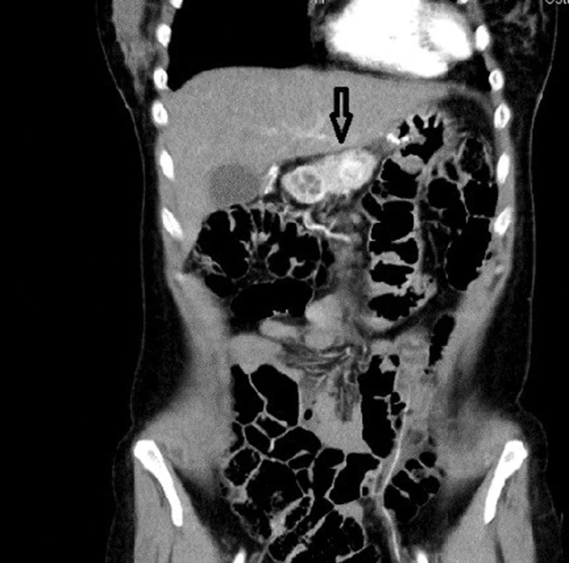 Léze v oblasti pankreatu u pacienta s MEN 1
Fig. 1: Pancreatic lesion in a patient with MEN 1