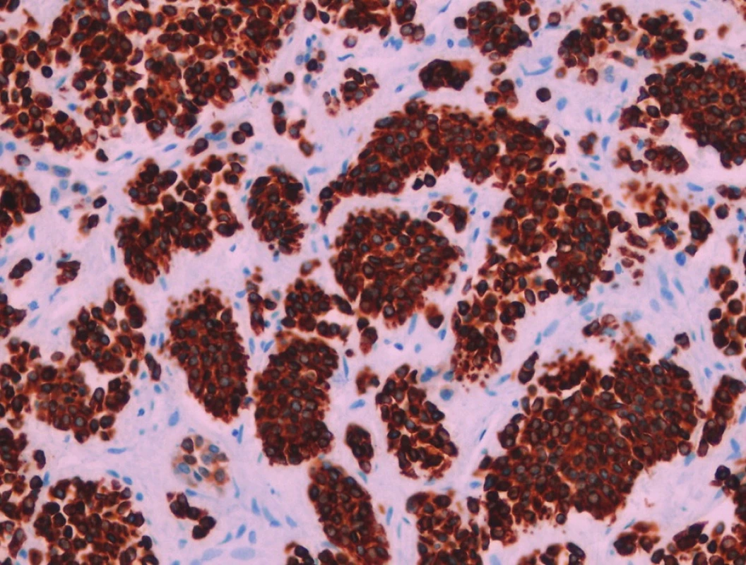 Nádorové buňky s expresí pancytokeratinů AE1-AE3. Imunohistologie, 400x