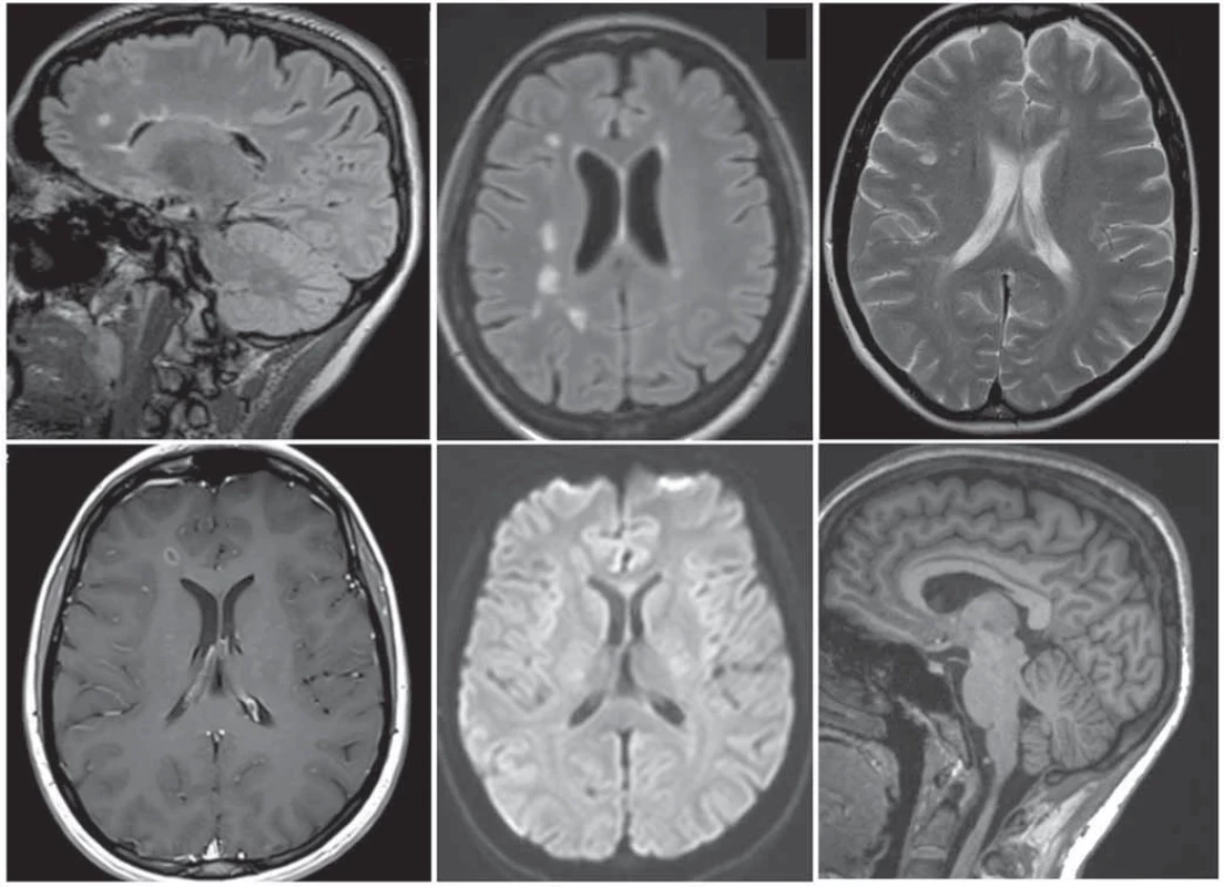 Bazální diagnostický protokol MR mozku dle konsensu panelu: (a) 3D FLAIR; (b) FLAIR transverzální rekonstrukce; (c) T2 vážený obraz v transverzální rovině; (d) postkontrastní T1 vážené zobrazení v transverzální rovině; (e) difuzí vážené zobrazení; (f) pokud lze, doplnění o 3D T1 vážený obraz s vysokým rozlišením a izotropním voxelem pro měření mozkové atrofi e.