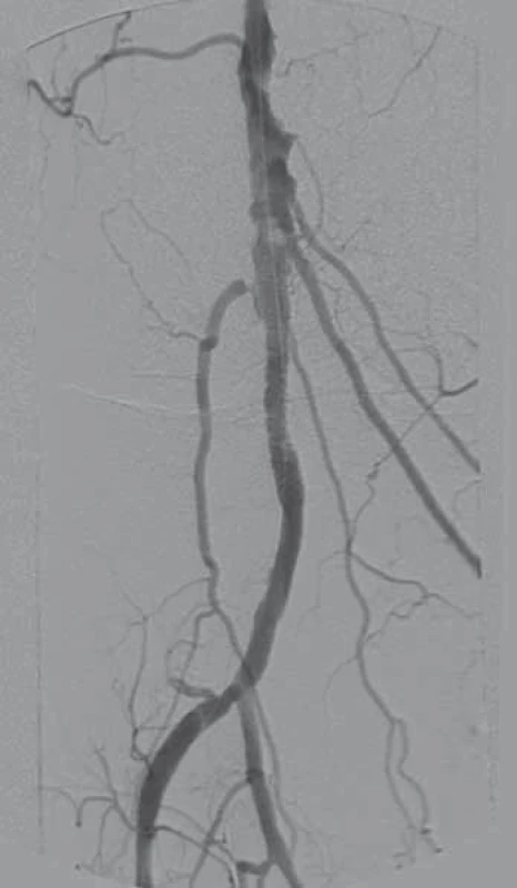 Úsek P2–3 po úspěšné revaskularizaci a následné implantaci stentu.