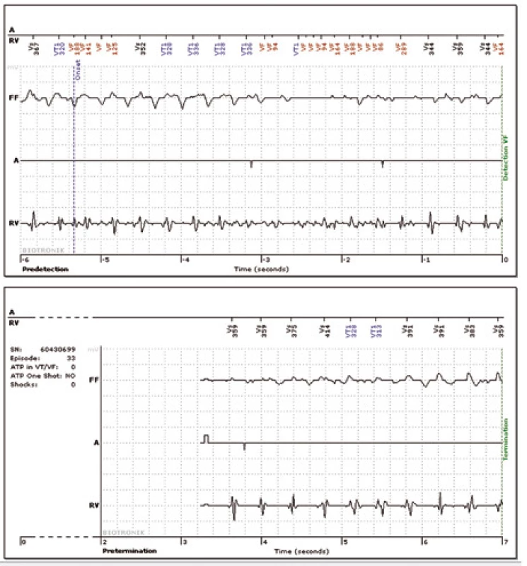 Intrakardiální elektrogram odeslaný službou Biotronik Home Monitoring