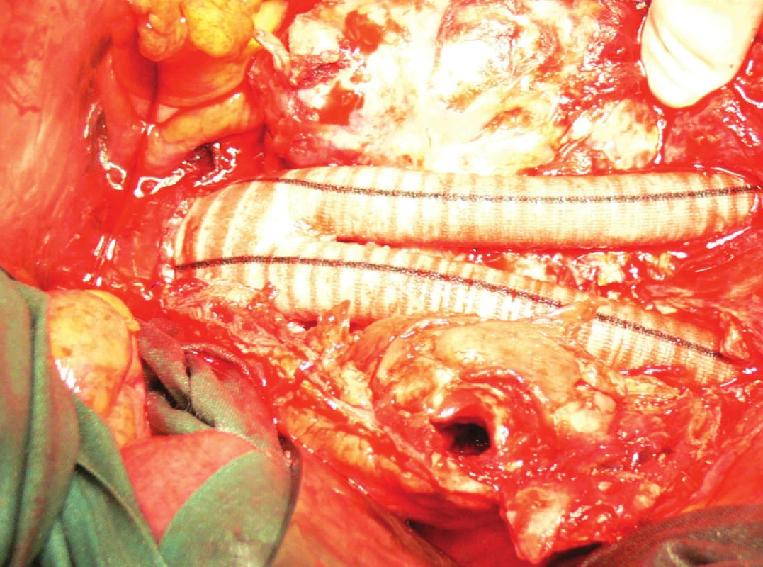 Aortobiilická náhrada, v nástěnném trombu patrný kanál po endoleaku
Fig. 12: Aortobiiliac replacement, in wall thrombus visible channel for endoleak