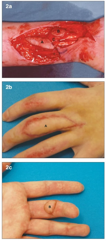 a. Bilobed arterialized venous flap. Flap harvested on the distal
volar forearm (7) A– Dorsal skin paddle. B – Volar skin paddle. C – subcutaneous bridge
between the two skin paddles
b. Early post-operative result at 1 month. A – Dorsal skin paddle
c. Early post-operative result at 1 month. B – Volar skin paddl