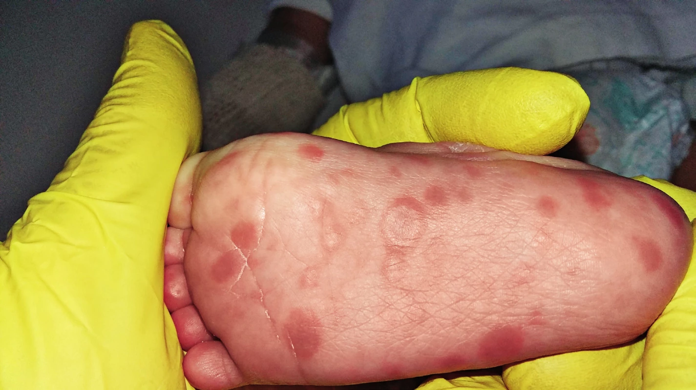 Detail plantárních syfilitických kožních lézí.
Fig. 2. Detail of plantar syphilitic skin lesions.