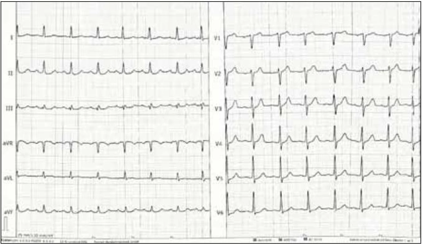 EKG popisovaného pacienta při vstupním vyšetření.