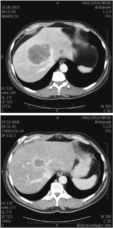 CT obraz, nahoře před chemoterapií, dole po chemoterapii
Fig. 1. CT view, prior to chemotherapy (upper) and following chemotherapy (lower)