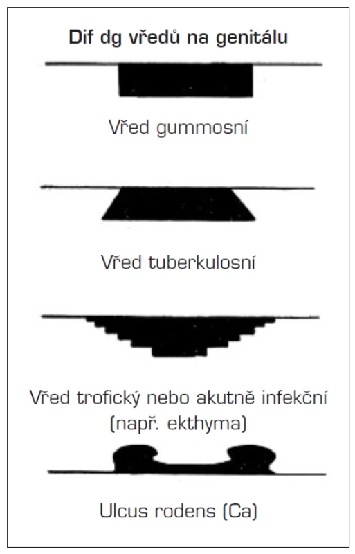 Schéma vzhledu vybraných vředů (upraveno dle Jiráska a Šťávy)
Štáva Z., Jirásek L. Dermatovenerologie. Avicenum, 1982