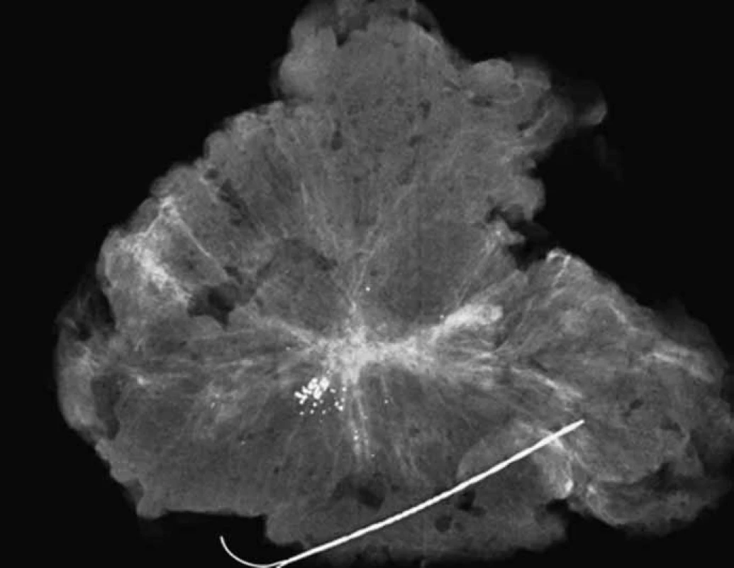 <em>Specimen radiography</em> – lokalizace výsevu mikrokalcifikací a nepravidelné pruhovitá adenomatoidní léze v těsném okolí u které stanovený cévně rezistenční index vykazoval maligní hodnoty. Histologicky: Z oblasti výsevu mikrokalcifikací verifikován in situ karcinom komedo + papilárního typu Grade 3, z pruhovité arey (na obr. centrálně) invazivní lobulární a komedonový karcinom mléčné žlázy. Hodnota steroidních receptorů negativní, ki 67 15%, Her2 +++, Fish pozitivní.